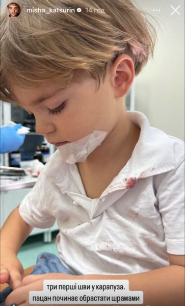 Миша Кацурин показал фото 3-летнего сына с повязкой на лице и рассказал, что произошло: "Первые швы"
Миша Кацурин показал фото 3-летнего сына с повязкой на лице и рассказал, что произошло: "Первые швы"