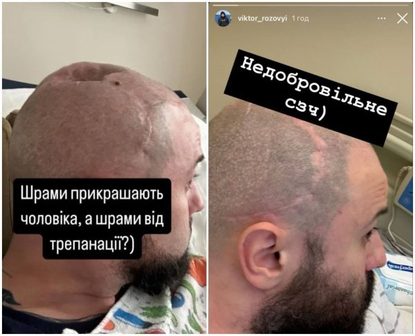 Виктор Розовый показал, как зажили шрамы после трепанации черепа в результате ранения на фронте
Виктор Розовый показал, как зажили шрамы после трепанации черепа в результате ранения на фронте