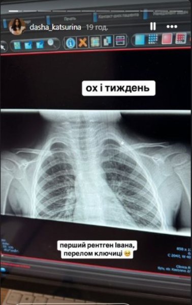 Даша Кацурина ошеломила фото 3-летнего сына с серьезной травмой
Даша Кацурина ошеломила фото 3-летнего сына с серьезной травмой