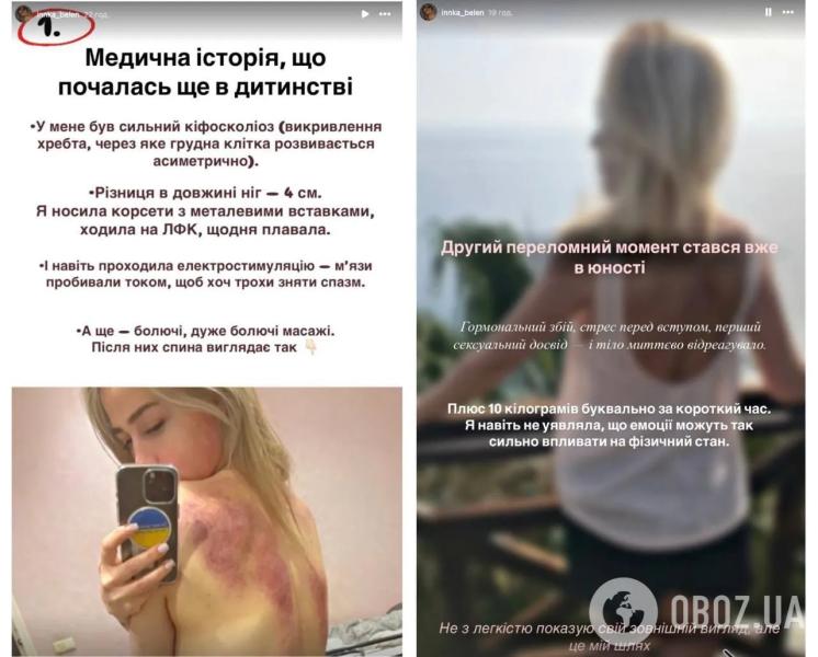 Бывшая девушка "Терена" Инна Белень сделала две пластические операции и рассказала, что изменила в себе. Фото