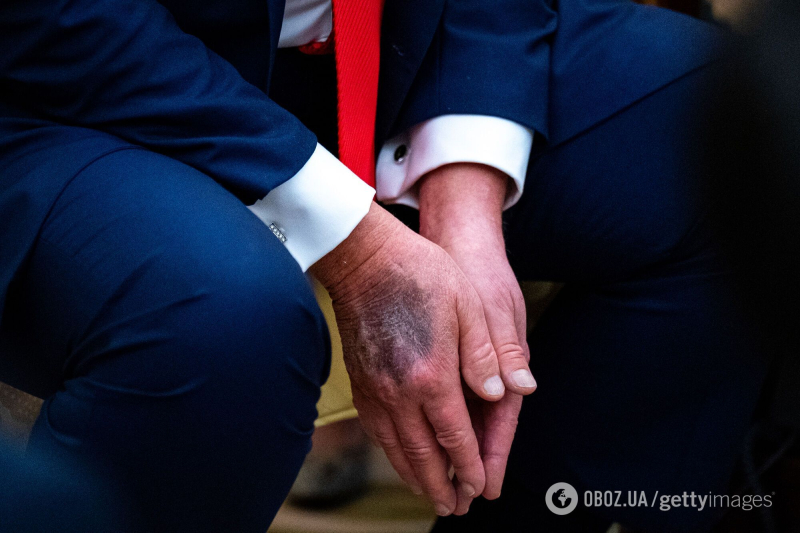 Белый дом раскрыл причину загадочных синяков на руках Трампа: перед смертью такие же замечали у Елизаветы II